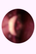 Bulimia