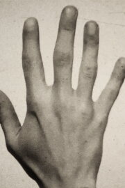 Fifth Metacarpal Fifth Metacarpal