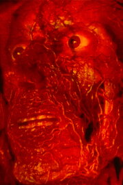 Permanentes Diarrhö und Hämorrhoiden Permanentes Diarrhö und Hämorrhoiden