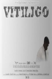 Vitiligo Vitiligo