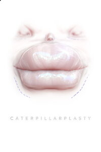 Caterpillarplasty (2018)