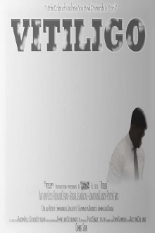 Vitiligo Trailer