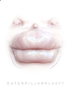 Caterpillarplasty (2018)