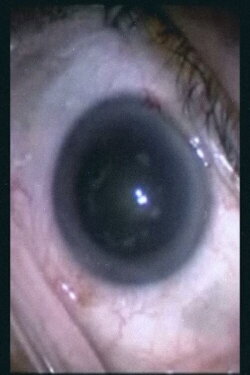 Botched Eyeball Operation (2007)