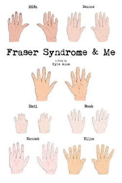 Fraser Syndrome & Me (2018) Fraser Syndrome & Me (2018)