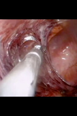 Laparoscopic Surgery (2020)