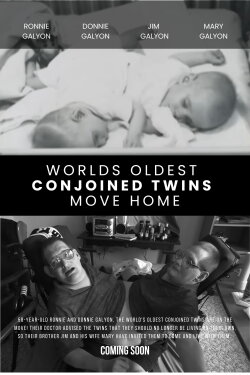 World's Oldest Conjoined Twins Move Home (2010) World's Oldest Conjoined Twins Move Home (2010)