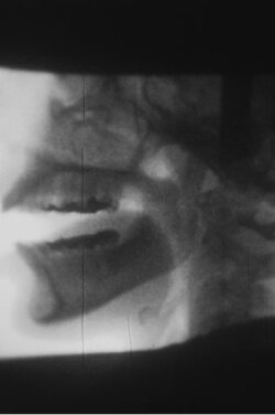 X-ray (1975)